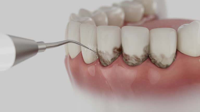 Trusted Wisdom Tooth Removal service in La Cresta, CA - Dentist Open Now